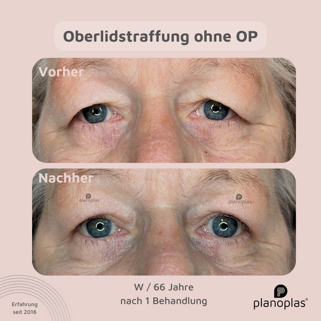 planoplas Plasma Pen Vorher Nachher Ergebnis einer Oberlidstraffung ohne OP w66 frontal geöffnete Augen