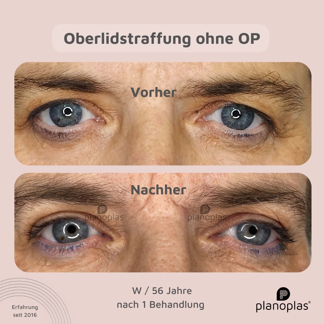 planoplas Plasma Pen Vorher Nachher Ergebnis einer Oberlidstraffung ohne OP frontal geöffnete Augen w56