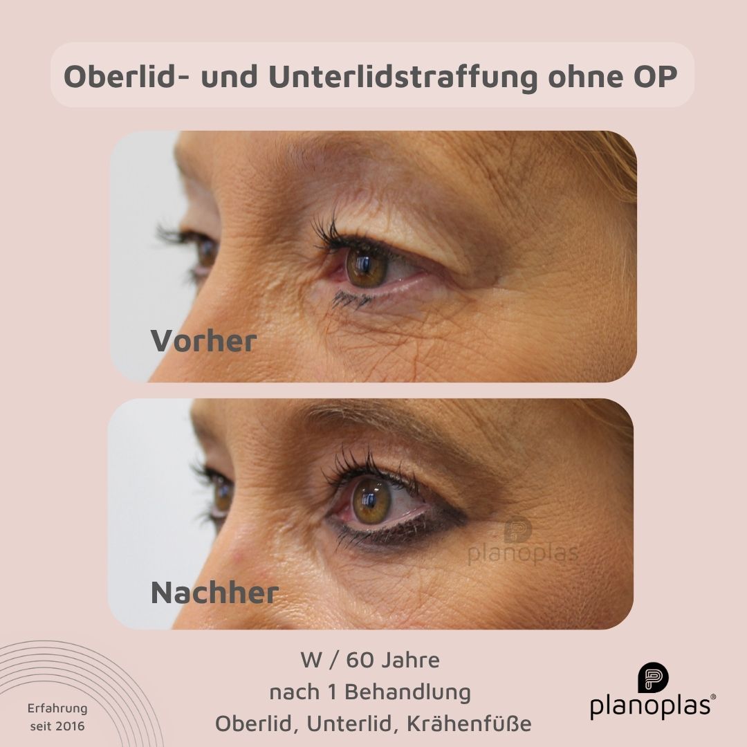 planoplas Plasma Pen Vorher Nachher Ergebnis einer Oberlid- und Unterlidstraffung ohne OP w60 von links geöffnete Augen