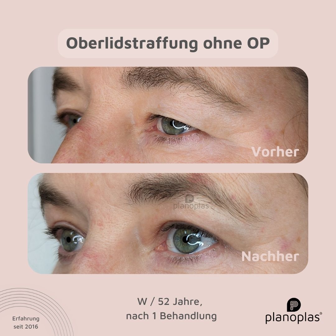 planoplas Plasma Pen Vorher Nachher Ergebnis einer Oberlidstraffung ohne OP w52 von links