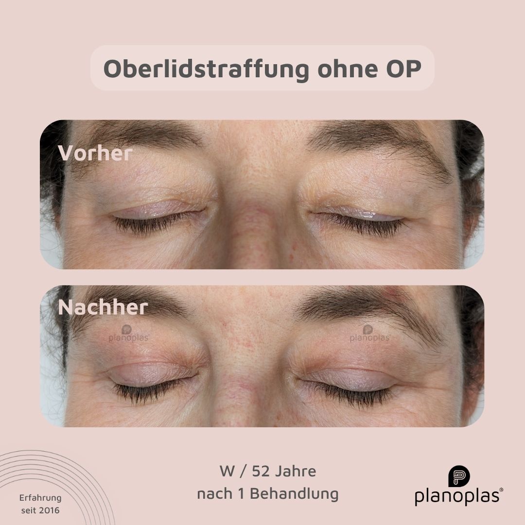 planoplas Plasma Pen Vorher Nachher Ergebnis einer Oberlidstraffung ohne OP frontal geschlossene Augen w52