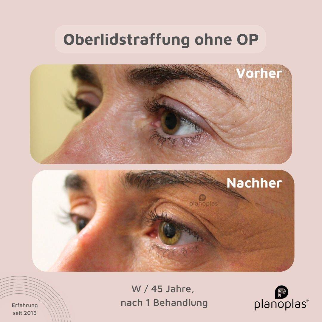 planoplas Plasma Pen Vorher Nachher Ergebnis einer Oberlidstraffung ohne OP w45 geöffnete Augen von links