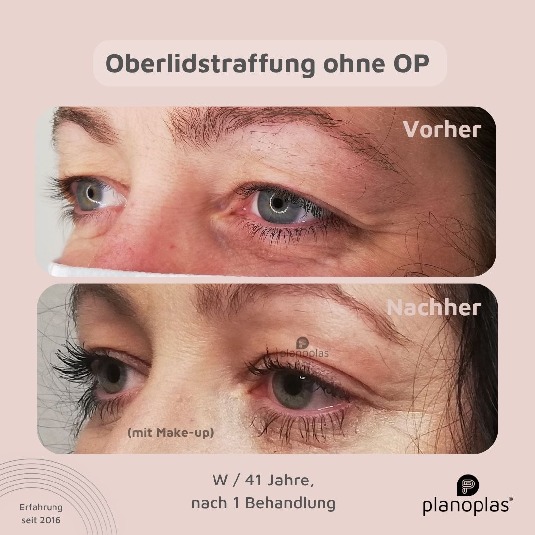 planoplas Plasma Pen Vorher Nachher Ergebnis einer Oberlidstraffung ohne OP w41 von links