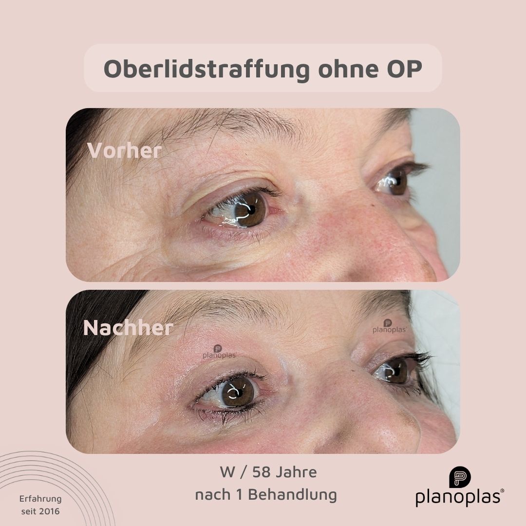 planoplas Plasma Pen Vorher Nachher Ergebnis einer Oberlidstraffung ohne OP w58 von rechts mit geöffneten Augen