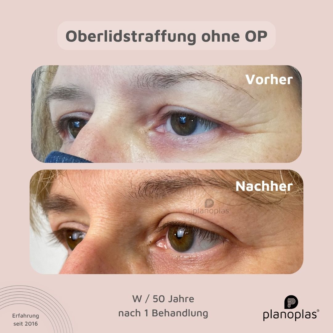 planoplas Plasma Pen Vorher Nachher Ergebnis einer Oberlidstraffung ohne OP w50 geöffnete Augen von links