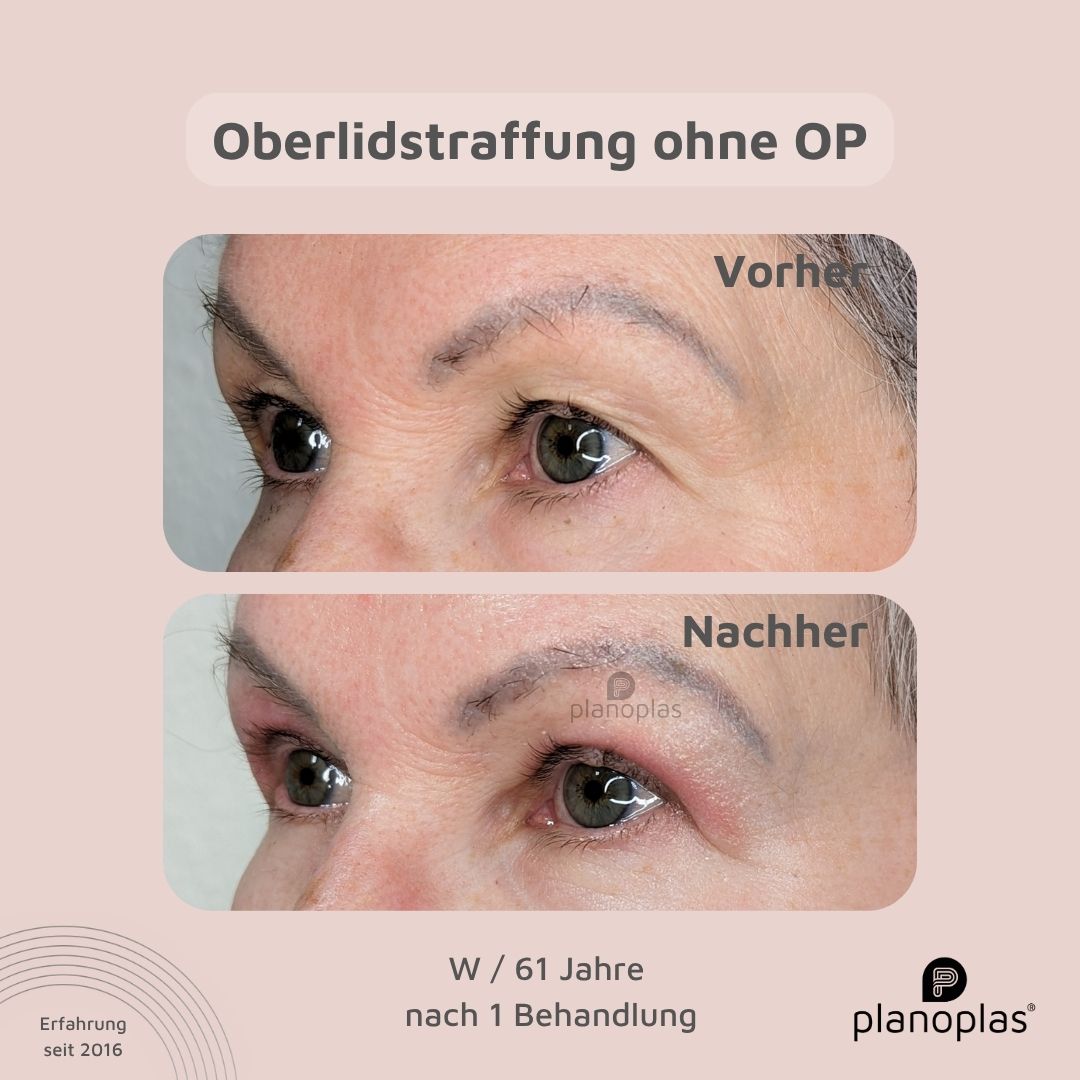 planoplas Plasma Pen Vorher Nachher Ergebnis einer Oberlidstraffung ohne OP von links w61 geöffnete Augen