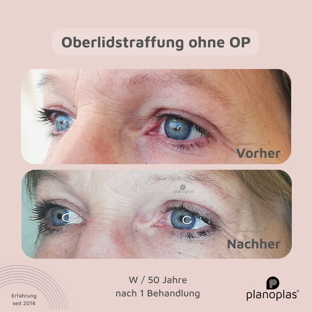 planoplas Plasma Pen Vorher Nachher Ergebnis einer Oberlidstraffung ohne OP w50 von links geöffnete Augen