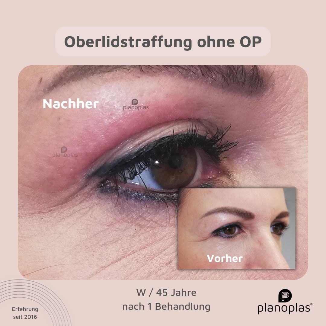 planoplas Plasma Pen Vorher Nachher Ergebnis einer Oberlidstraffung ohne OP von rechts w45 mit geöffneten Augen