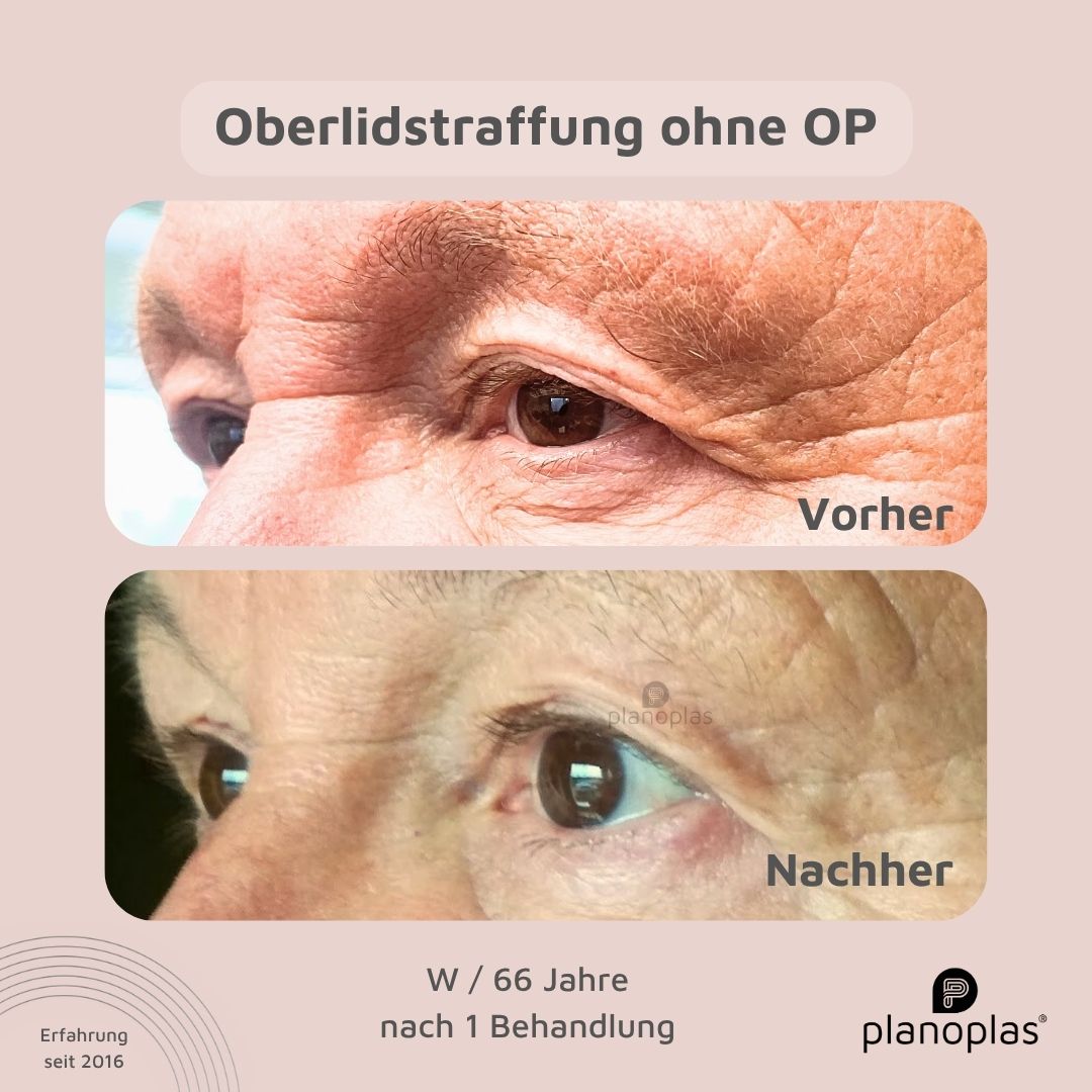 planoplas Plasma Pen Vor0her Nachher Ergebnis einer Oberlidstraffung ohne OP m66 geöffnete Augen von rechts