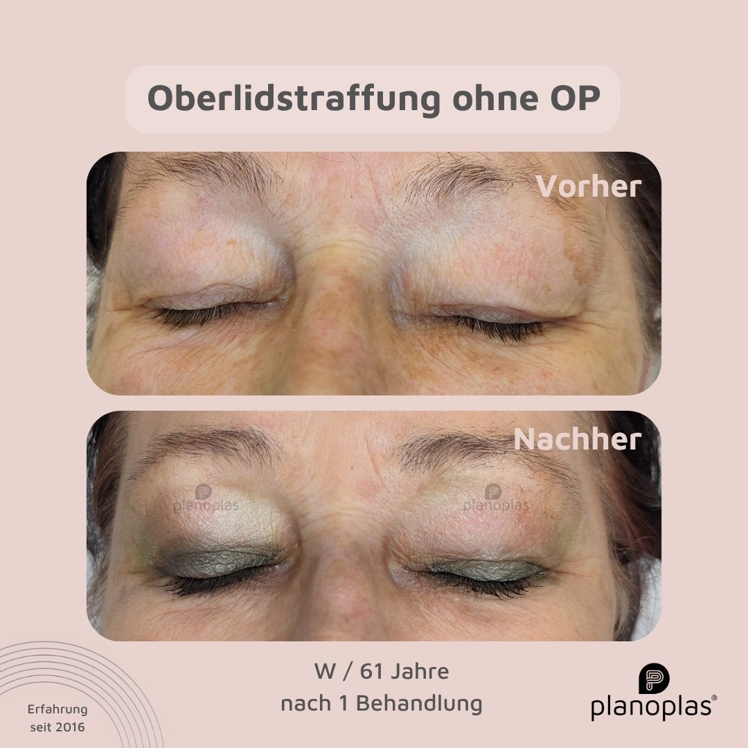 planoplas Plasma Pen Vorher Nachher Ergebnis einer Oberlidstraffung ohne OP w61 frontal geschlossene Augen