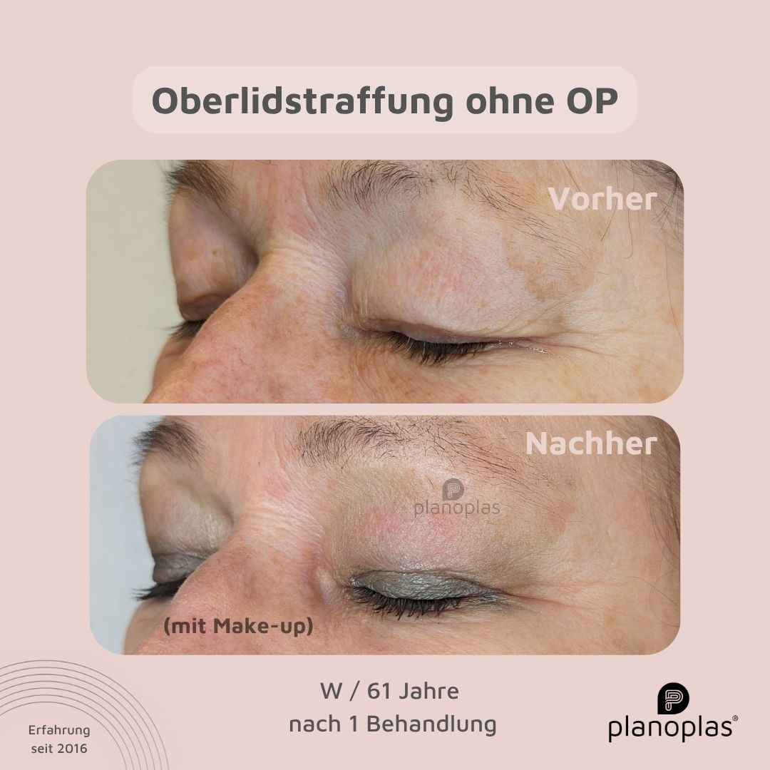 planoplas Plasma Pen Vorher Nachher Ergebnis einer Oberlidstraffung ohne OP von links geschlossene Augen