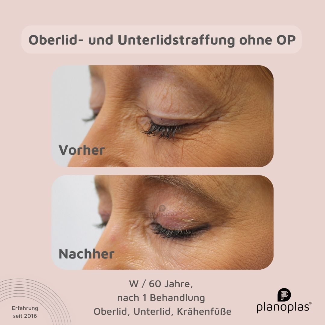 planoplas Plasma Pen Vorher Nachher Ergebnis einer Oberlidstraffung ohne OP w60 von links geschlossene Augen