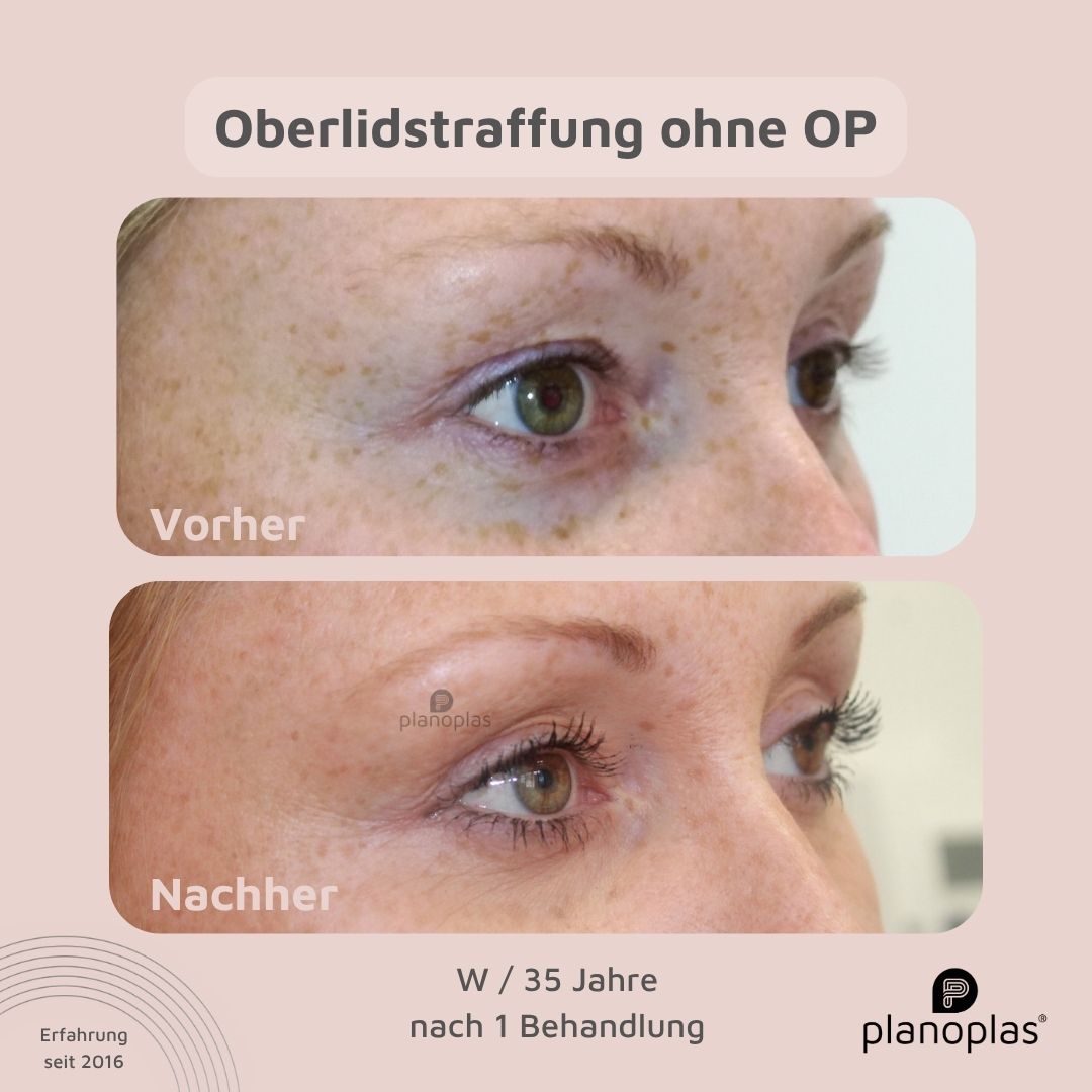 planoplas Plasma Pen Vorher Nachher Ergebnis einer Oberlidstraffung ohne OP w35 von links geöffnete Augen
