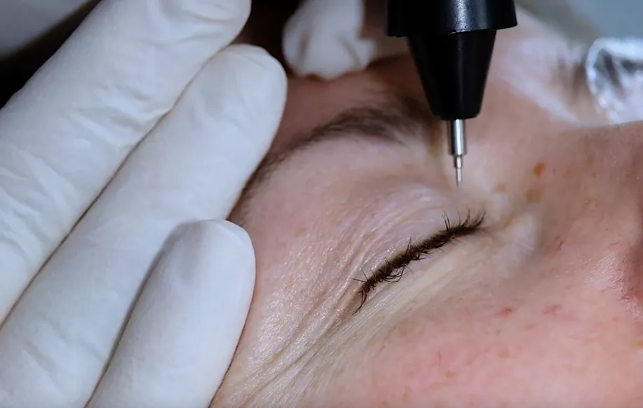 Plasma Pen Behandlung mit sichtbarem Plasma-Funken