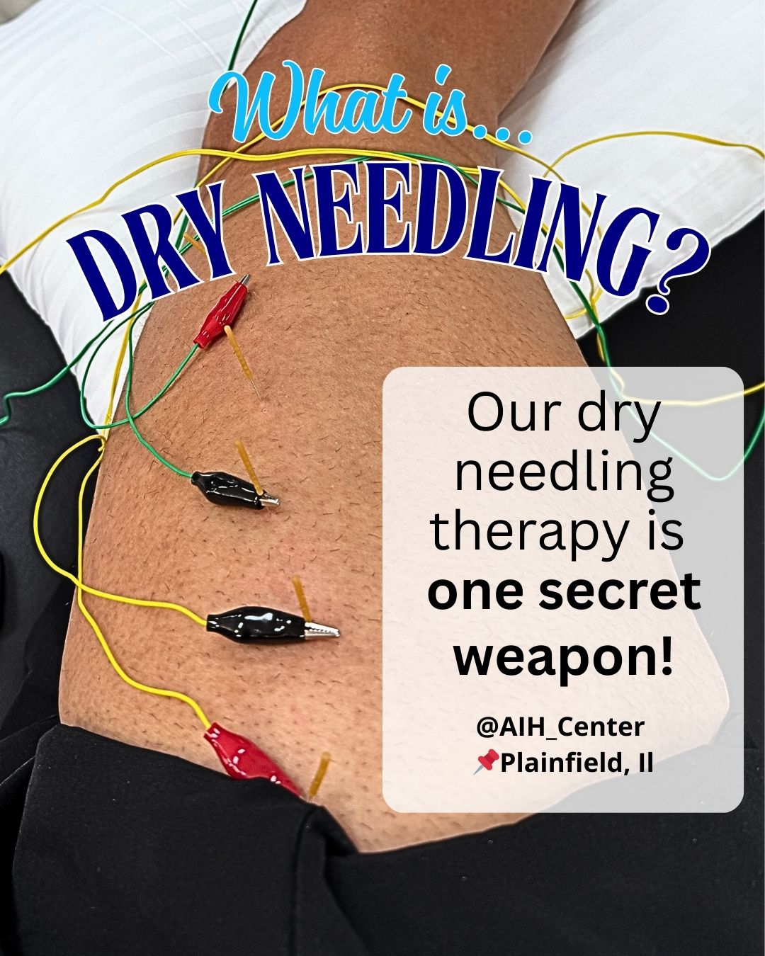 Dry Needling in Plainfield, IL: Release Muscle Knots & Reduce Chronic Pain