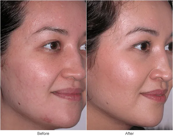 Before & After - Superb Skin Clinic