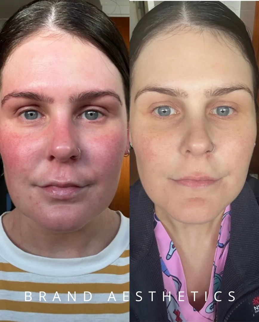 Skin Needling