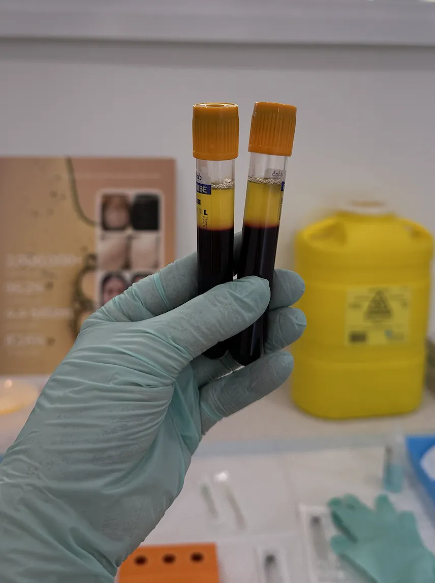 PRF (Platelet-Rich Fibrins)