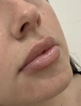 Face Volume Enhancement 
