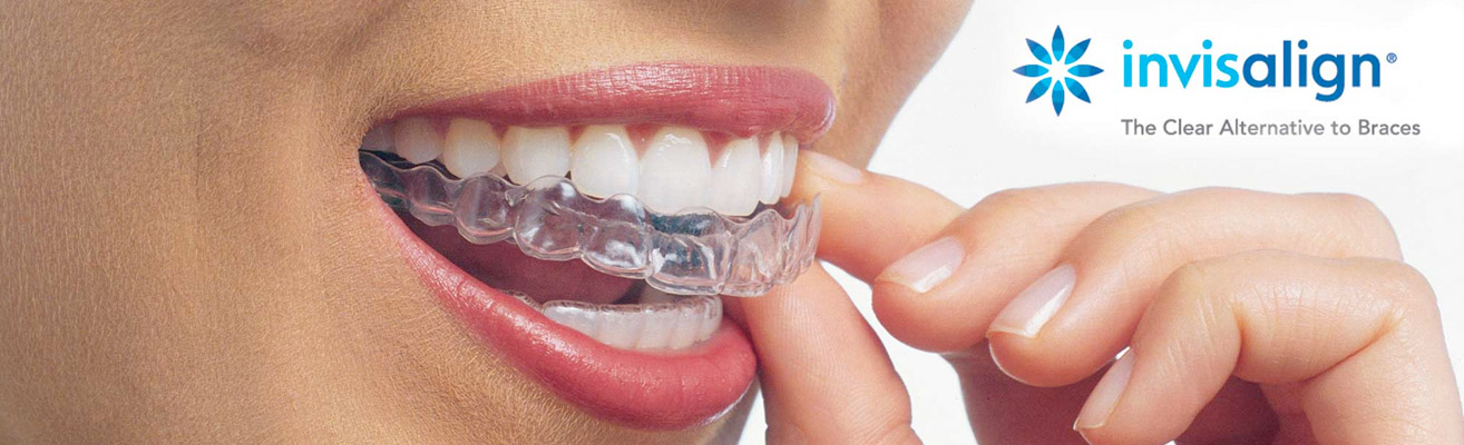 invisalign