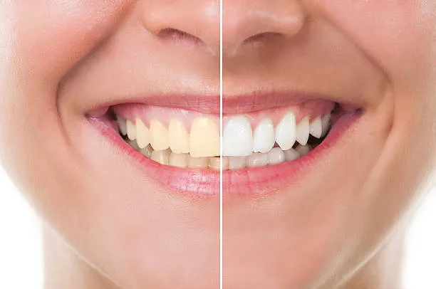 Teeth Whitening 