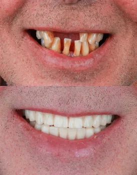 Permanent Implants