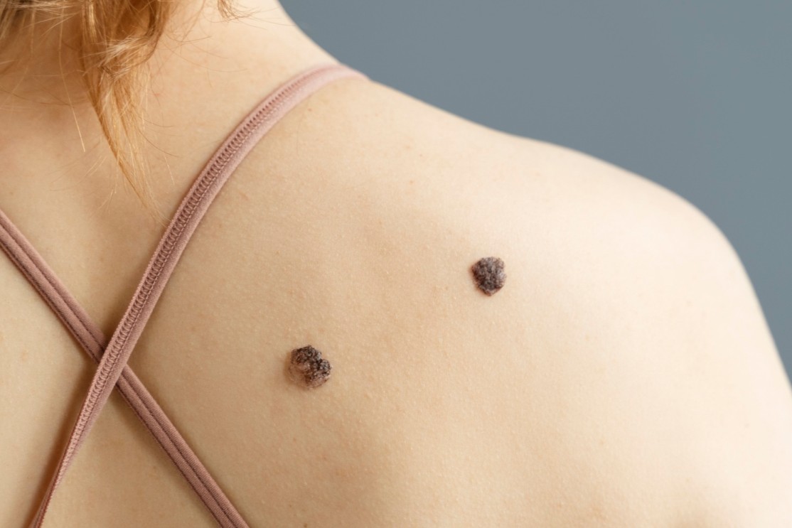 Skin Lesion Removal johor bahru