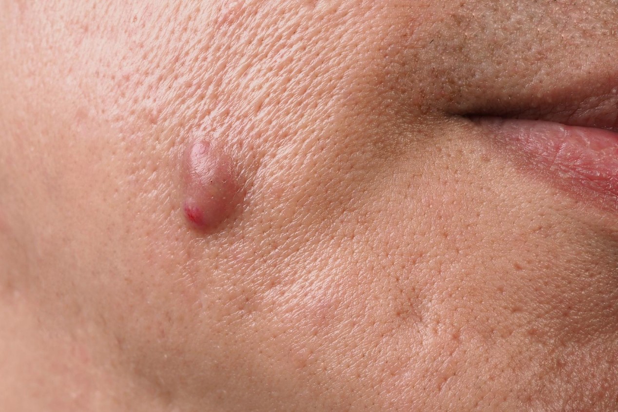 Abscess & Cyst Drainage johor bahru