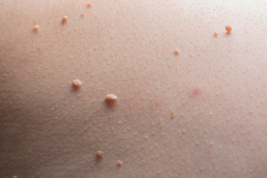 Skin Tag & Wart Removal johor bahru