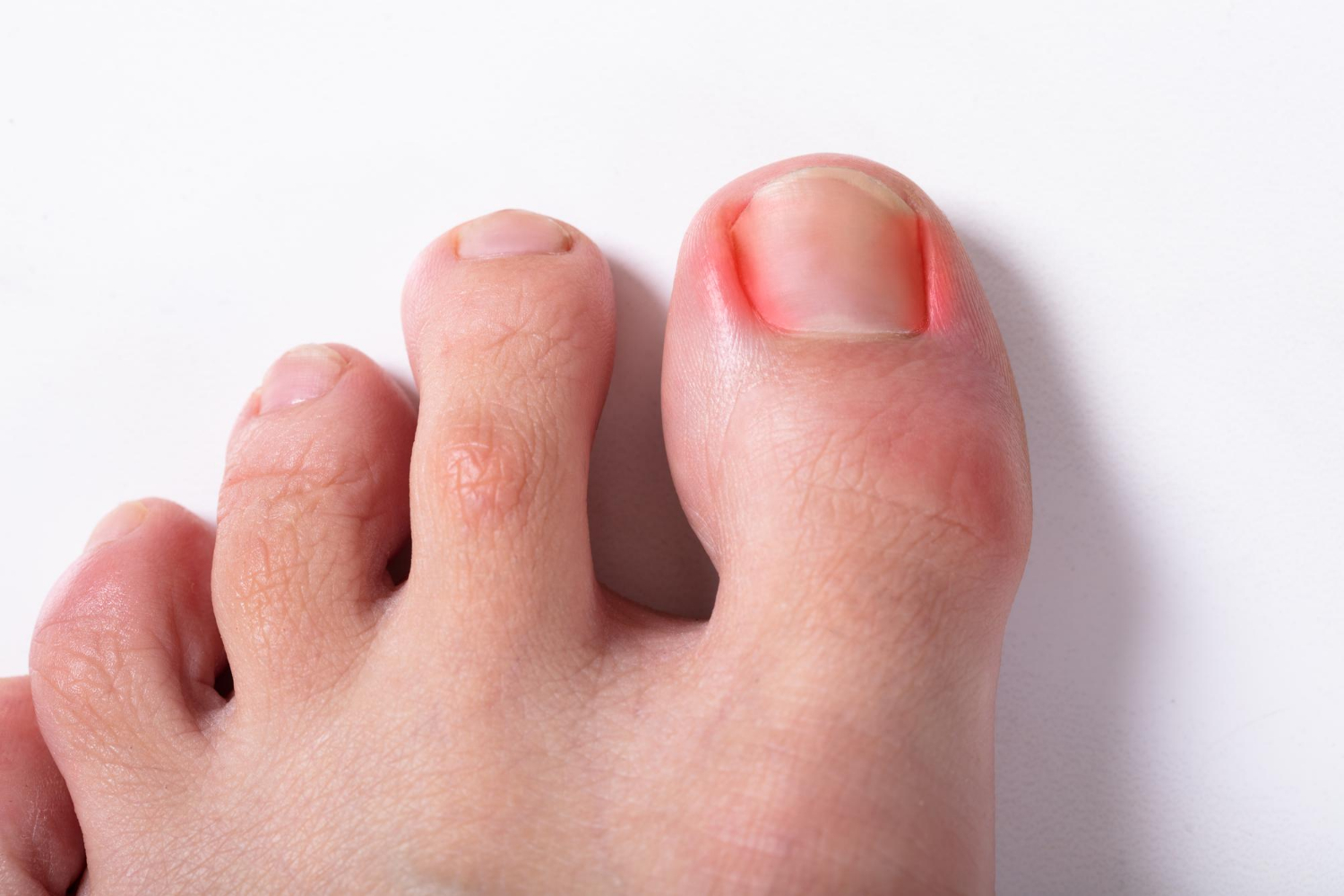 Ingrown Toenail Removal johor bahru