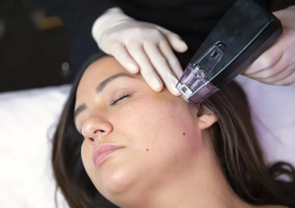 A provider performing a cosmetic microneedling treatment on a client's forehead with a morpheus8 by inmode device