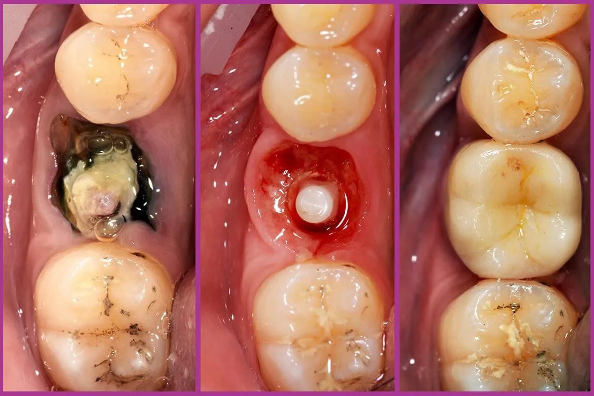 before and after zirconia dental implant