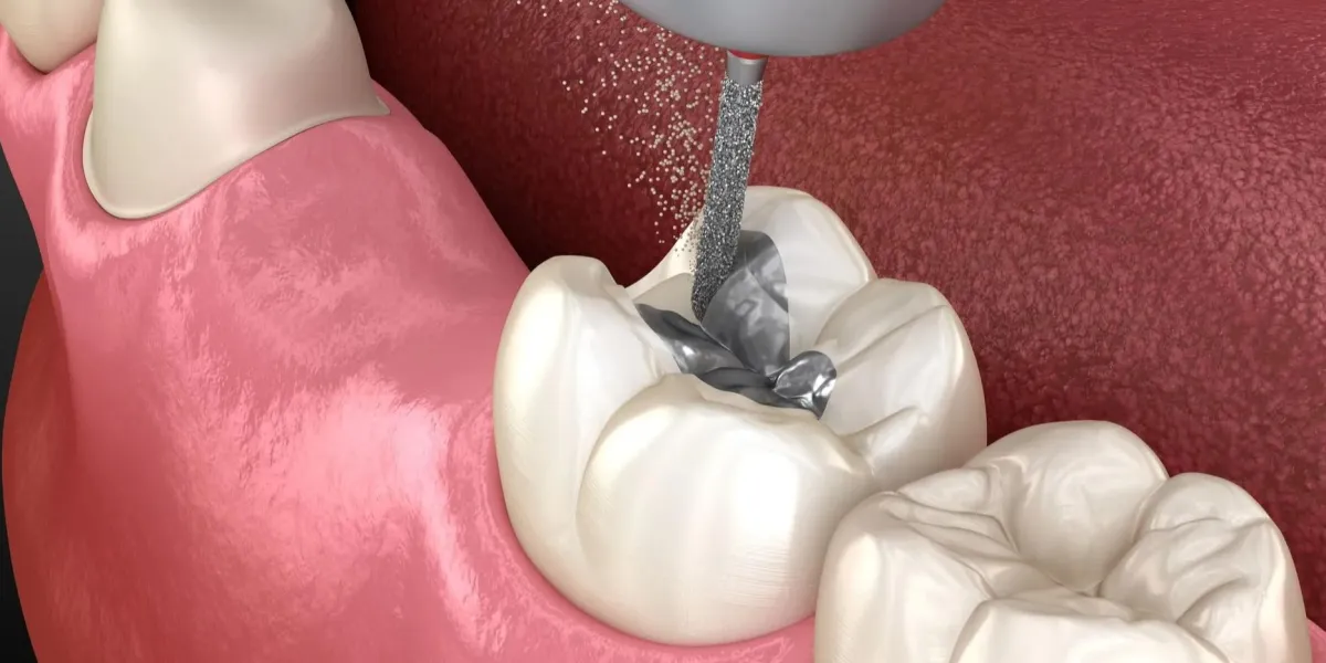 Gentle Amalgam Removal