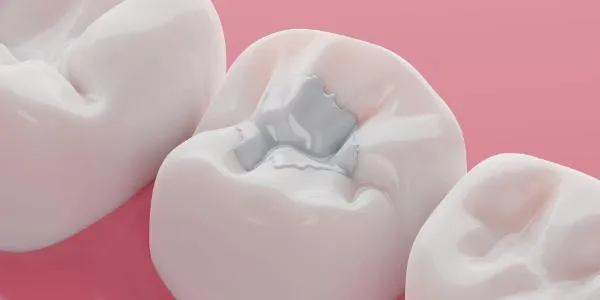 Mercury-Safe Restorations