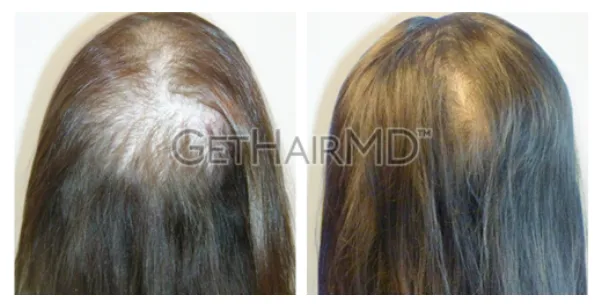Before and after photos of laser hair restoration treatment