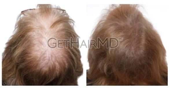 Before and after photos of laser hair restoration treatment