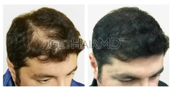 Before and after photos of laser hair restoration treatment