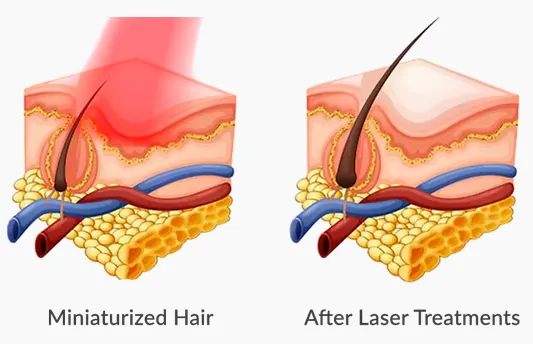 Drawing of hair follicles before and after treatment