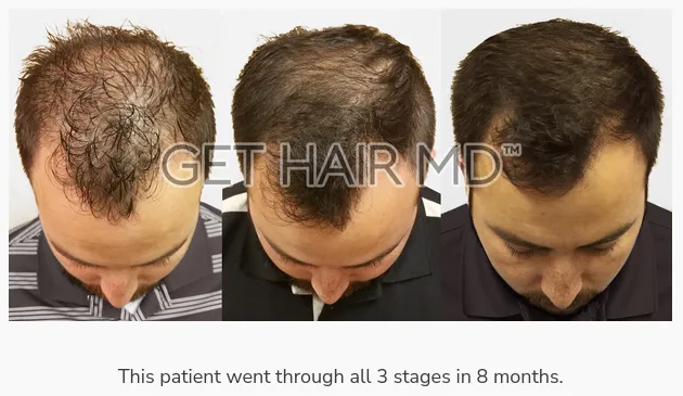 Before and after photos of laser hair restoration treatment