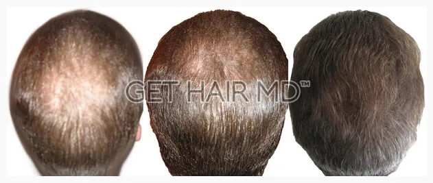 Before and after photos of laser hair restoration treatment