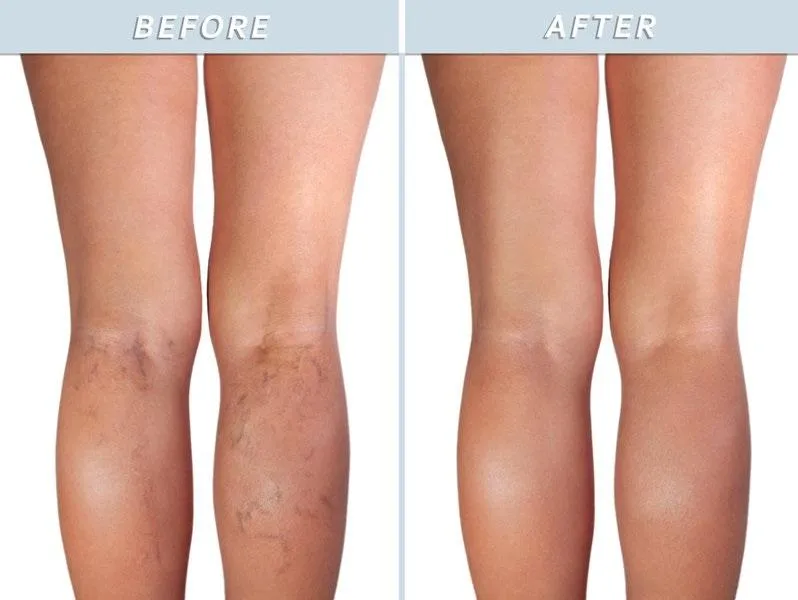 Profesional realizando un resurfacing láser de la piel