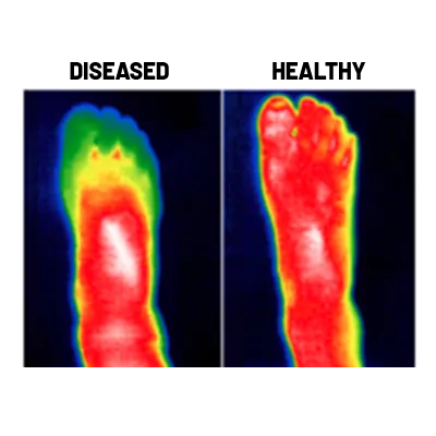 Nerve Damage Screening for Neuropathy