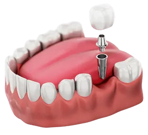 full mouth dental implants