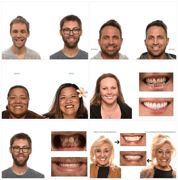 collage of before and after photos of dental implants