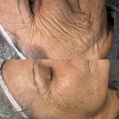 Ansikts-EMS behandling med professionell utrustning