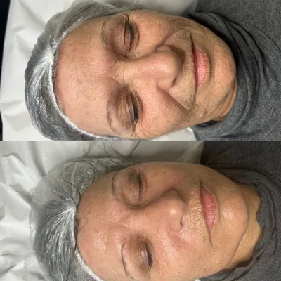 Ansikts-EMS behandling med professionell utrustning