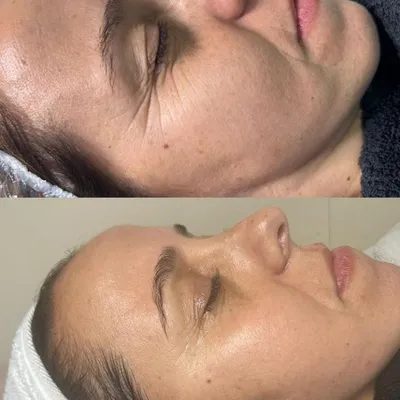 Ansikts-EMS behandling med professionell utrustning