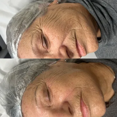 Ansikts-EMS behandling med professionell utrustning