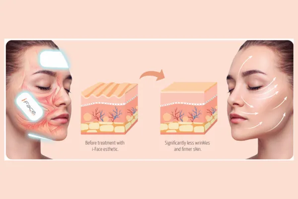i-face EMS-terapi på klinik för ansiktsmuskler