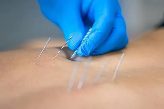 Clinical dry needling therapy applied to muscular trigger points on shoulder